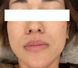 リジュラン施術後